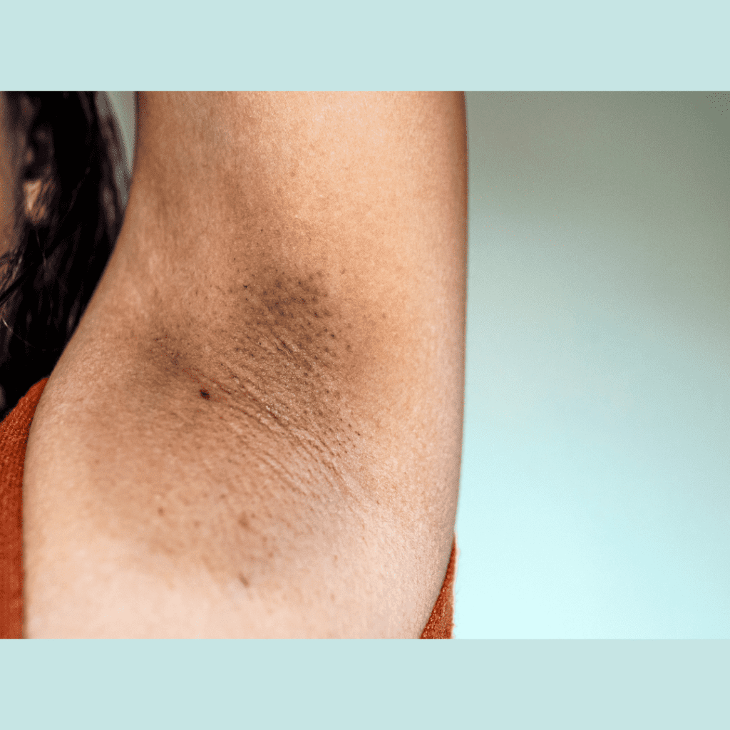 Como Clarear Virilhas E Axilas Em Casa: Dicas Naturais E Acessíveis 3 Axilias manchas