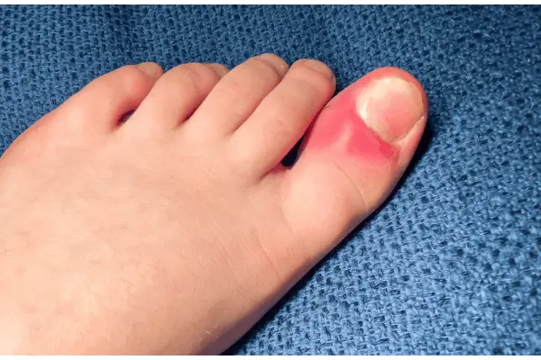 Como Cuidar Das Suas Unhas Em Casa: Guia Completo Para Iniciantes (Passo A Passo) 3 Unhas encravadas secao 7 1